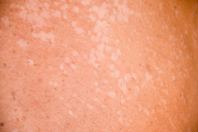 Причины появления белых пятен на коже после загара и провоцирующие заболевания и отклонения в организме