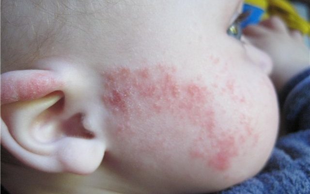 Как проявляется аллергия на плесень в квартире у детей?