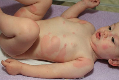 Очень часто на теле ребенка красными пятнами проявляется крапивница