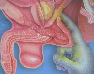 Разновидности массажа уретры и предстательной железы