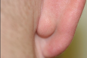 Жировик или внутренний прыщ на мочке уха