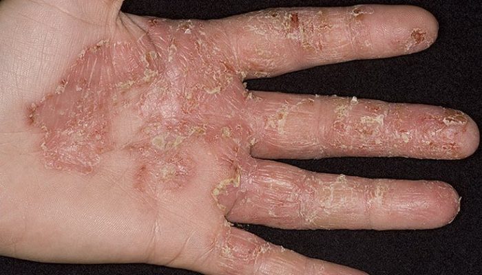 Симптомы и лечение дисгидроза кистей рук: можно ли избавиться от кожной болезни?