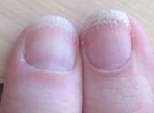 Начальная стадия грибка ногтей на ногах и на руках: фото и лечение