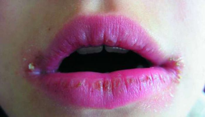 Самые распространенные причины воспаления губ и способы, как быстро лечить хейлит?