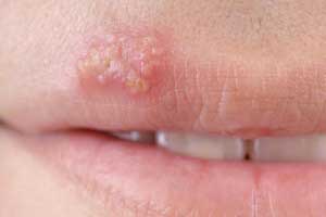 Народное лечение простуды на губах