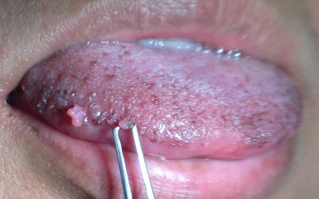 Почему возникают и как лечатся кондиломы во рту? Советы профессионалов