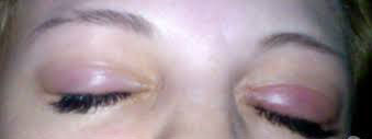 Почему болят глаза после наращивания ресниц