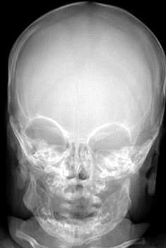 Рентген черепа больного младенческим кортикальным гиперостозом