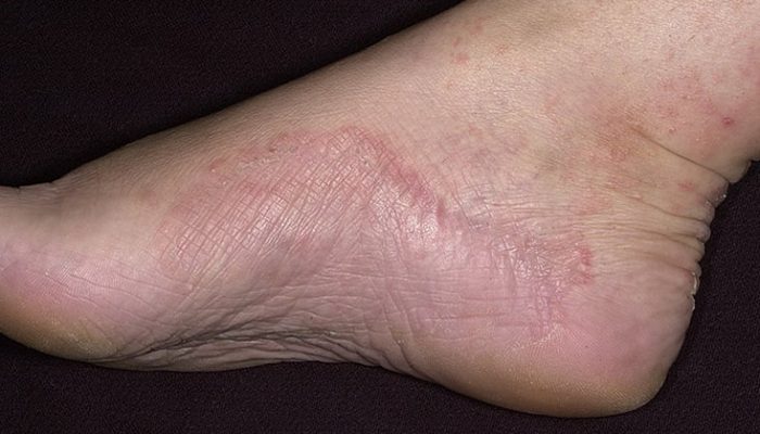 Кожные заболевания на ногах
