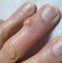 Шишка на пальце руки под кожей у ногтя thumbnail