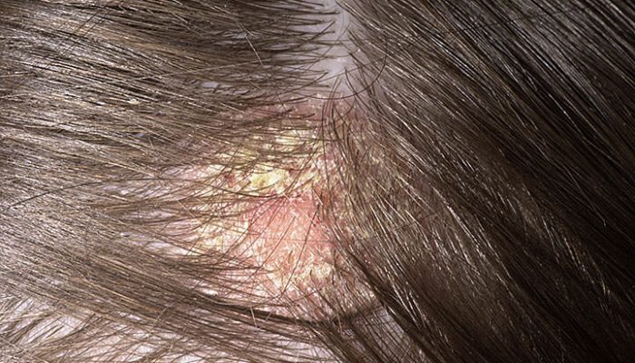Разбираем распространенные заболевания кожи головы у детей и взрослых, а также методы их лечения