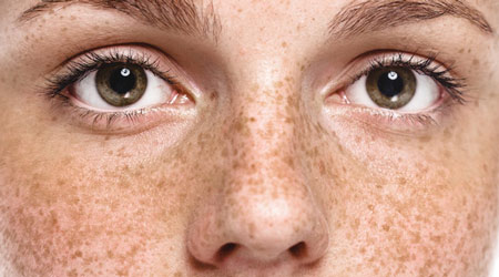 Веснушки - причина появления мелких коричневых пятен на коже лица