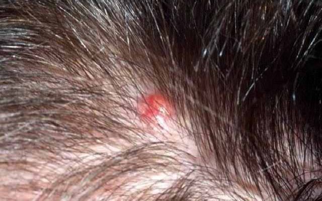 Фурункул на голове в волосах: лечение