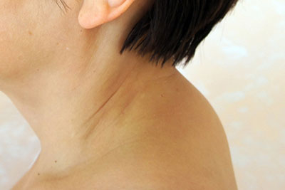Шишка на спине под кожей болит при нажатии фото thumbnail