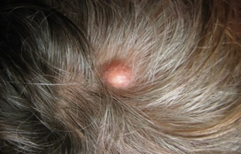 прыщи на голове в волосах у женщин: причины и лечение