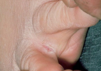 Появление трещин в складках нежной кожи на ноге