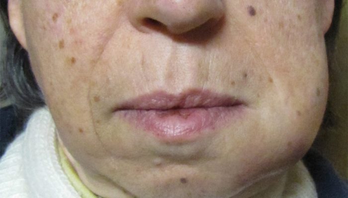 Абсцесс на лице: симптомы и лечение