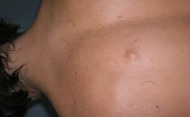 Атерома кожи спины: воспаление и удаление