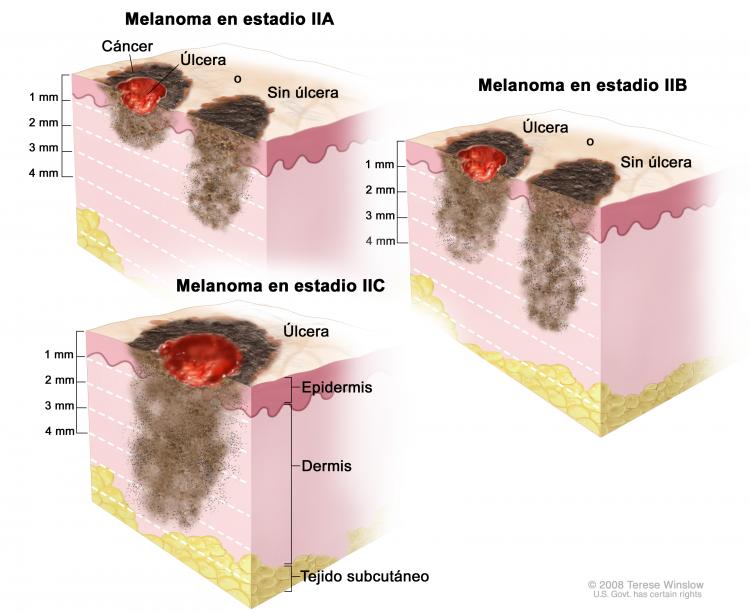 Прогноз и методы лечения меланомы в зависимости от ее стадии