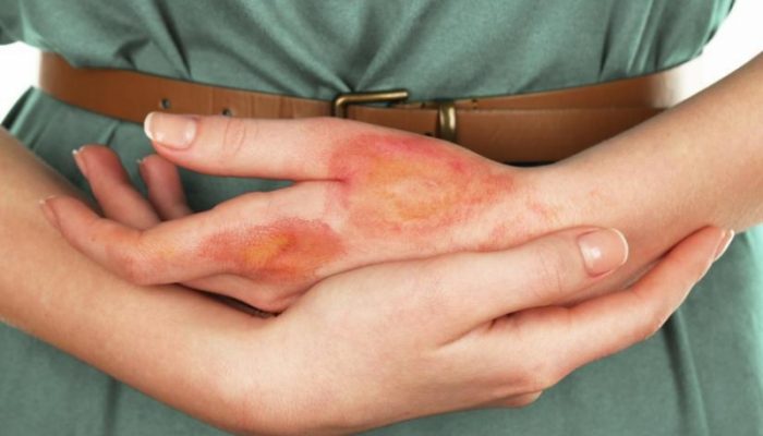Пятна и шрамы от ожога: лучшие рекомендации по лечению рубцов и отбеливанию пигментации