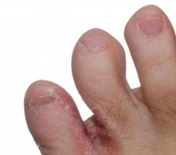 Кожное заболевание - грибок, поразивший пальцы ног