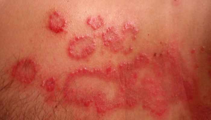 Симптомы и лечение аллергии на лекарства: как избавиться от проявлений непереносимости?