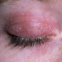 Причины появления покраснения и шелушения кожи вокруг глаз