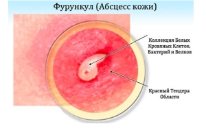 фурункулы в интимной зоне