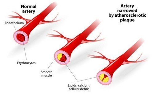 Атеросклероз - проявление гиперлипидемии