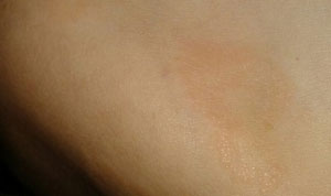 Ксантомами называют новообразования на коже, появляющиеся вследствие нарушения обмена липидов