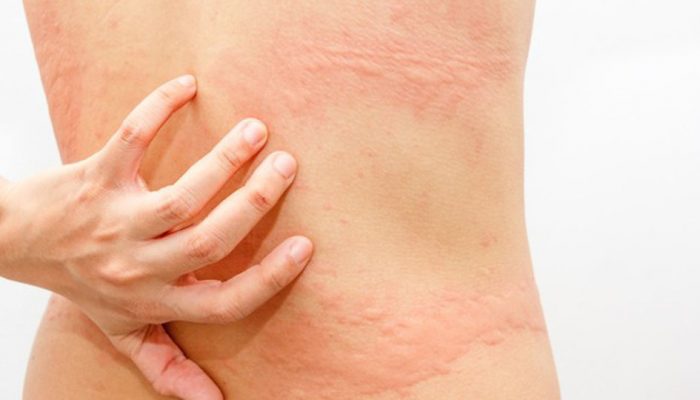 Почему возникает сыпь на теле? Самые распространенные причины и методы устранения