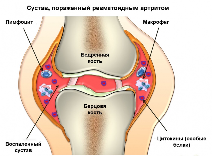 пораженный артритом сустав