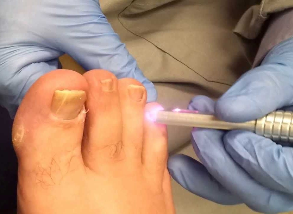 Удаление грибка ногтей лазером