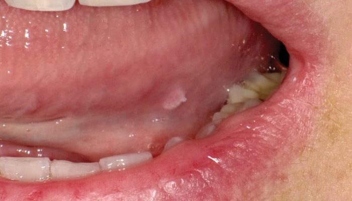 Почему возникает папиллома во рту? Симптомы и лечение новообразования