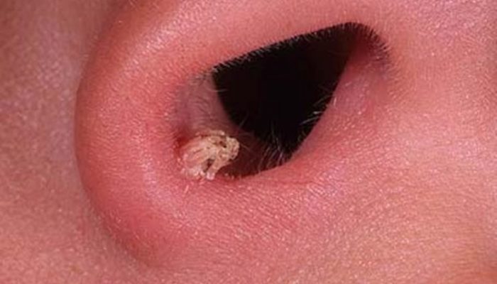 Почему образуются папилломы в носу? Симптомы, диагностика и лечение болезни