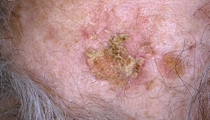 Виды, симптомы и лечение плоскоклеточного рака кожи