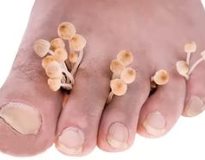  Чем лечить грибок на ногах и между пальцами: недорогие и эффективные препараты
