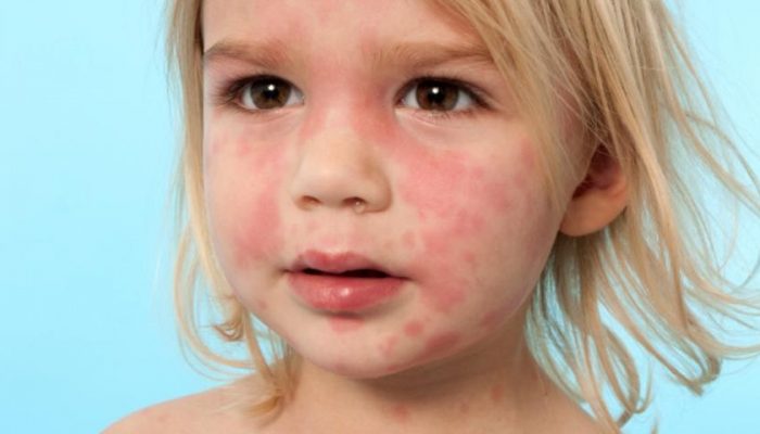 Почему возникает, как выглядит и лечится аллергия на лице?