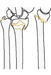 Внесуставной перелом локтевой кости (простой и вколоченный)