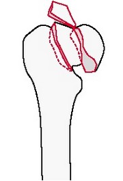 Внутрисуставной перелом головки бедренной кости с переломом шейки