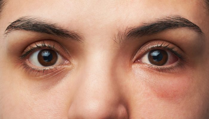 Почему возникают отеки под глазами? Таблетки, народные средства и другие способы лечения