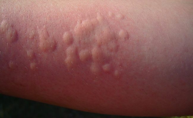 Причины уртикарных высыпаний на коже