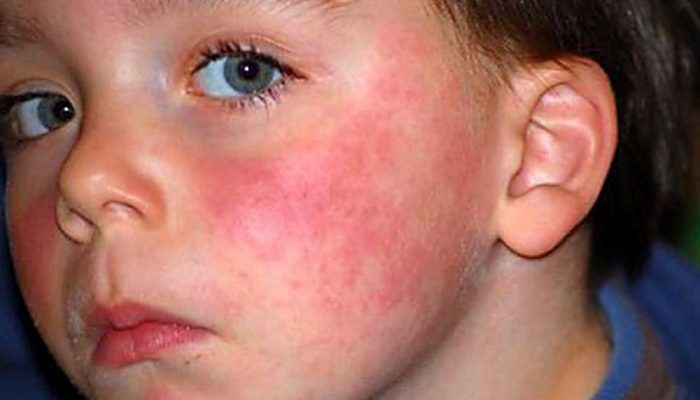 Как проявляется и чем лечится аллергия на солнце? Лучшие лекарства для детей и взрослых