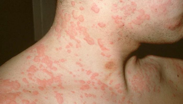 Бывает ли аллергия на семечки? Причины, симптомы и лечение болезни