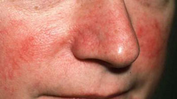 Мелкая сыпь возле носа фото thumbnail
