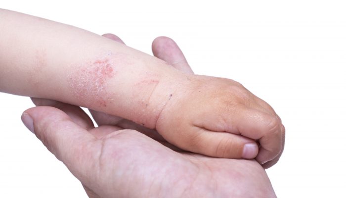 Как выглядит и протекает дерматит на руках? Способы лечения болезни