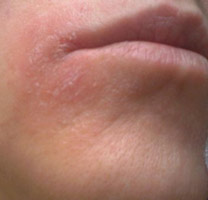 Раздражение вокруг рта (шелушиться кожа) - с чем это связано и что делать?