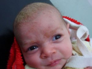 Почему возникает себорейный дерматит на голове у ребенка?