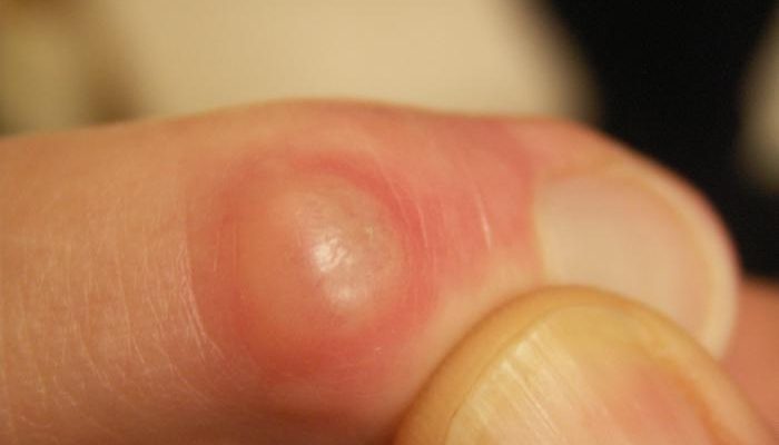 Почему возникает нарост на пальце руки? Методы лечения проблемы