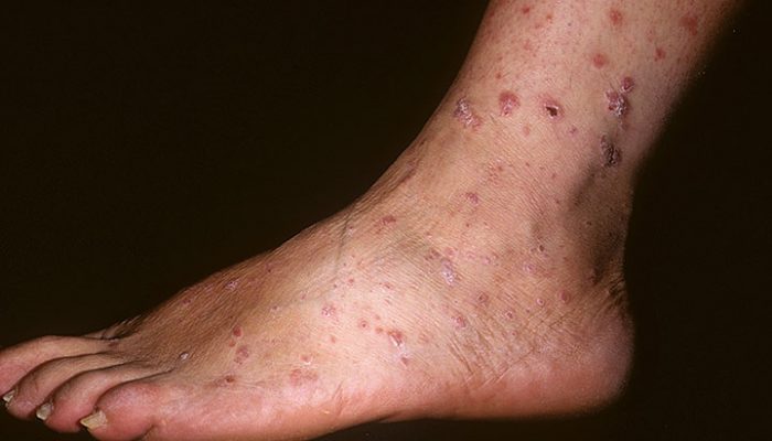 Псориаз на ногах: симптомы и методы лечения